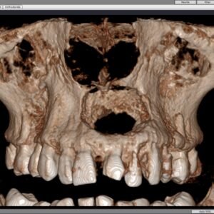 Maxillary Lesion(Anterior view)
