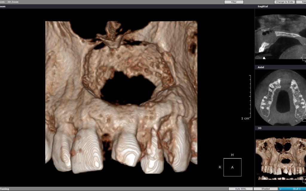 Maxillary Lesion (Anterior view 3D zoom)