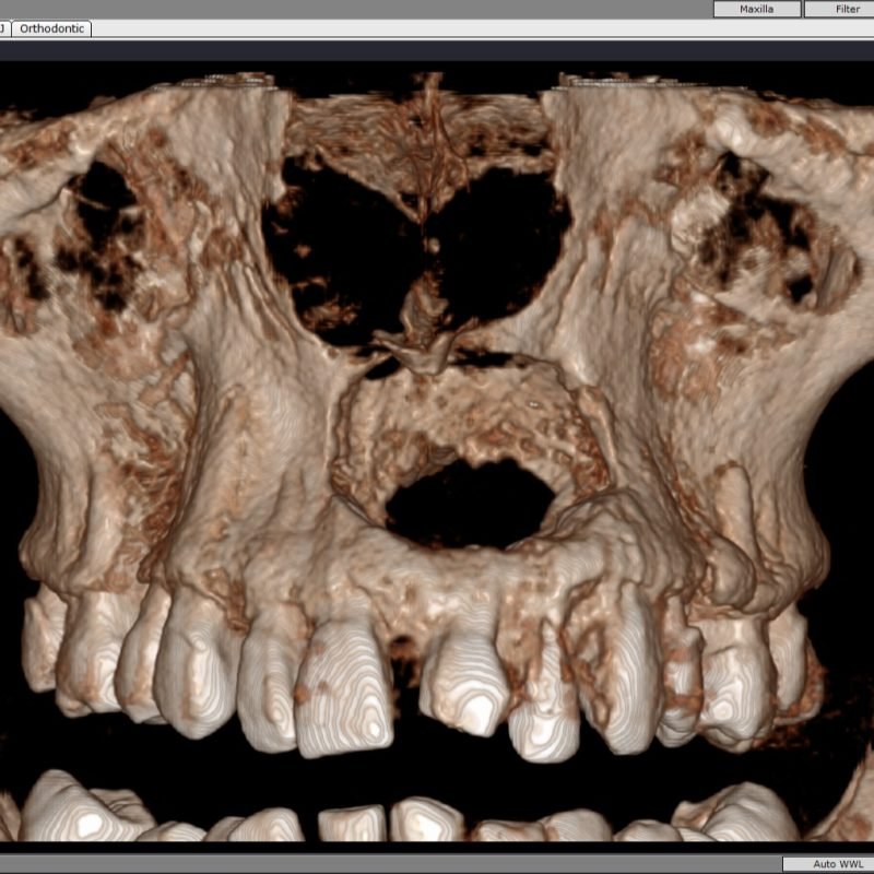 Maxillary Lesion(Anterior view)